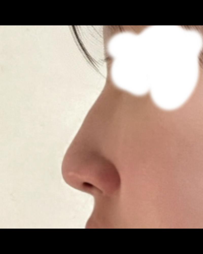 콧대(보형물) 후기