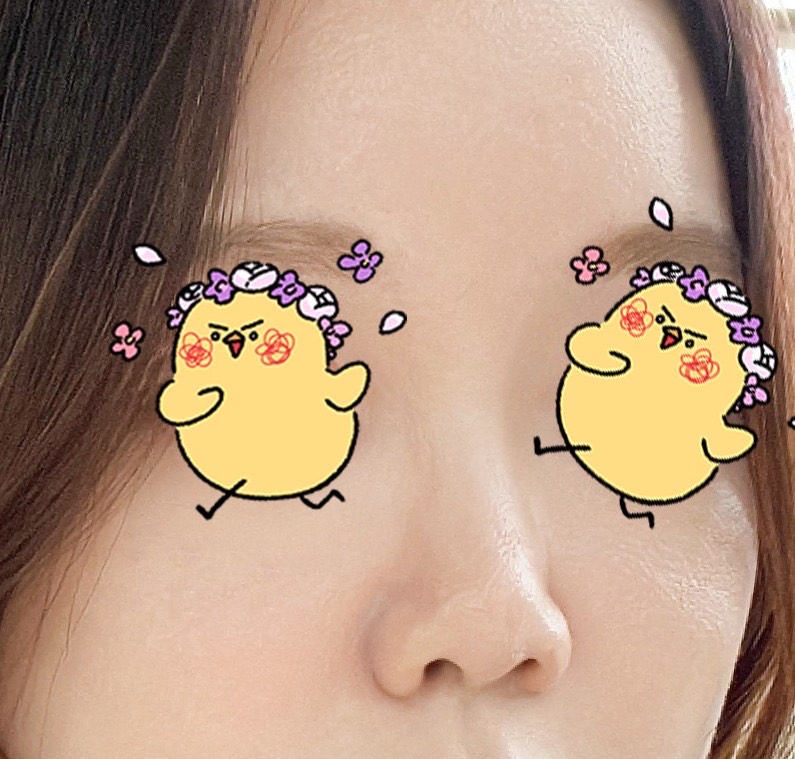 콧볼축소 후기