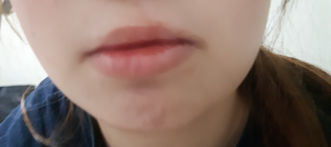 입꼬리성형 후기