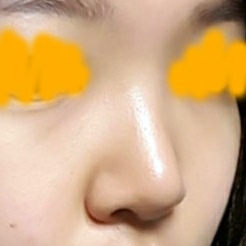코끝(자가연골) 후기