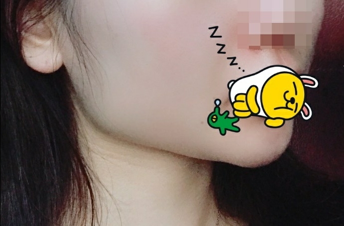 사각턱수술 후기