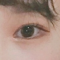 눈재수술 후기