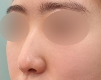 코절골술 후기