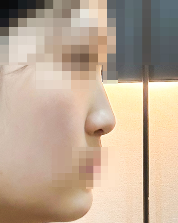 코끝(기증연골) 후기
