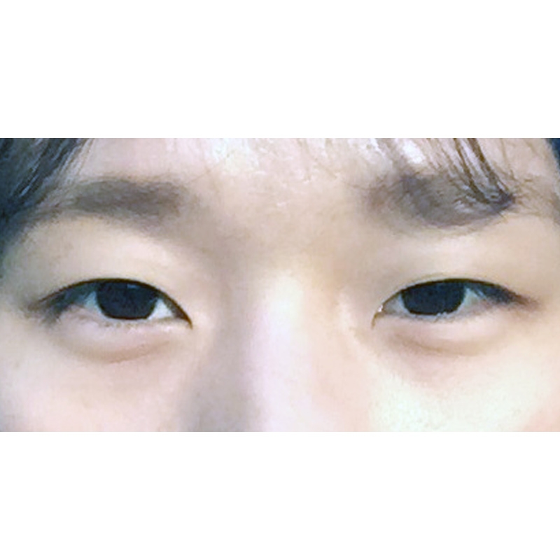 쌍꺼풀(절개) 후기