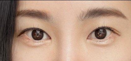 눈재수술 후기