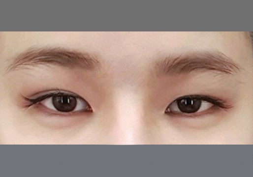 눈재수술 후기
