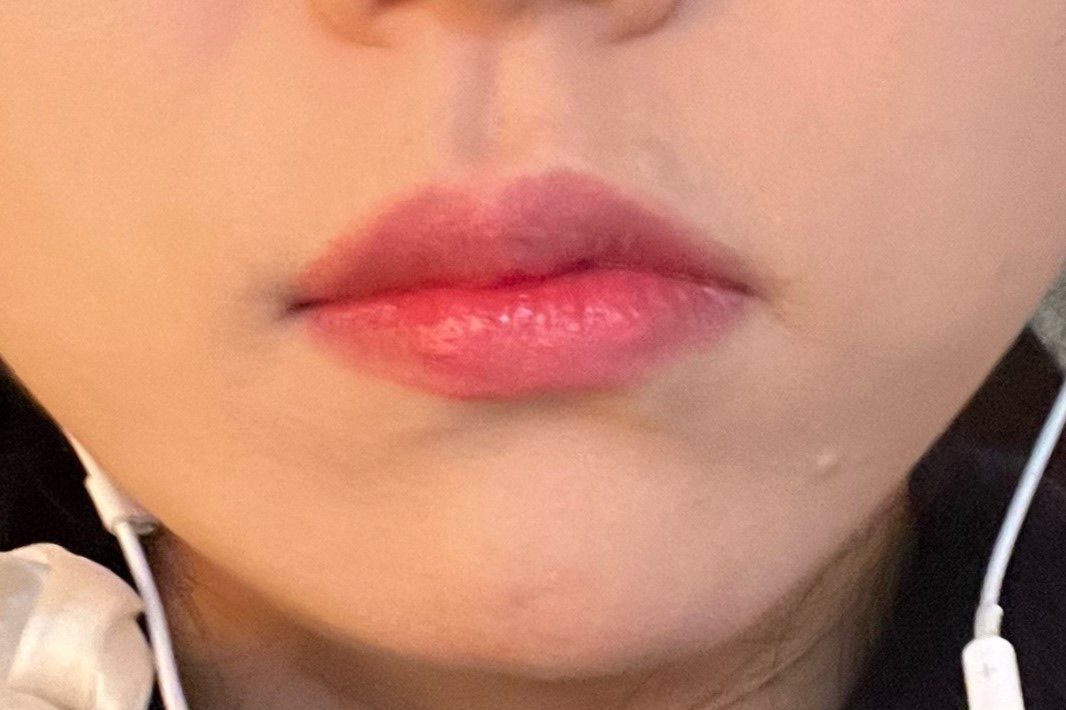 입술필러 후기