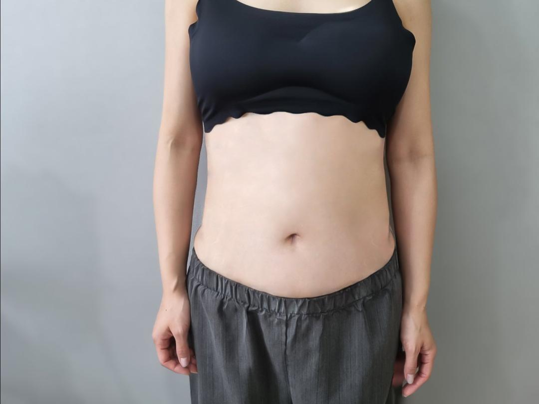 복부지방흡입 후기