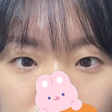 쌍꺼풀(절개) 후기