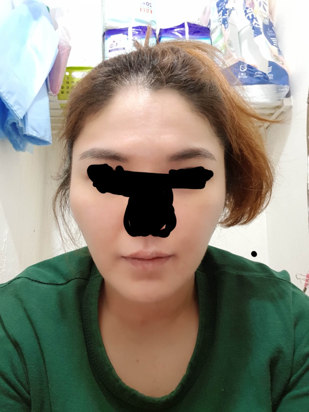사각턱수술 후기