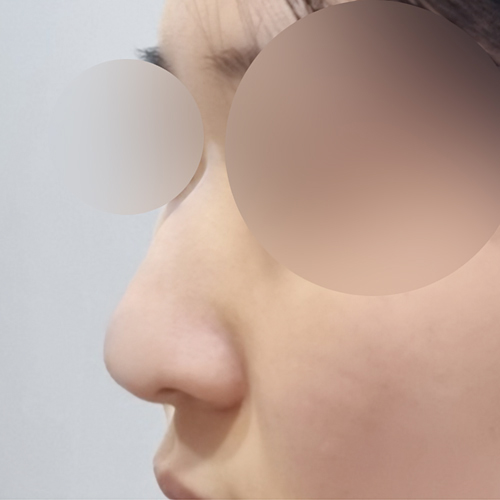 콧대(보형물) 후기