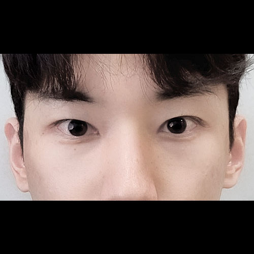 쌍꺼풀(매몰) 후기