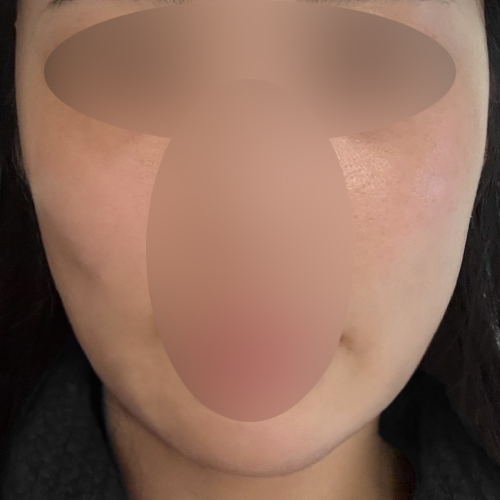 실리프팅 후기
