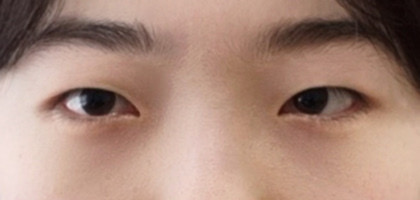 쌍꺼풀(절개) 후기