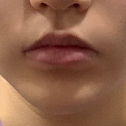 입꼬리성형 후기