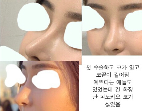 코재수술 후기