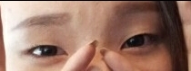 쌍꺼풀(절개) 후기