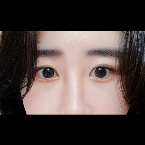 밑트임 후기