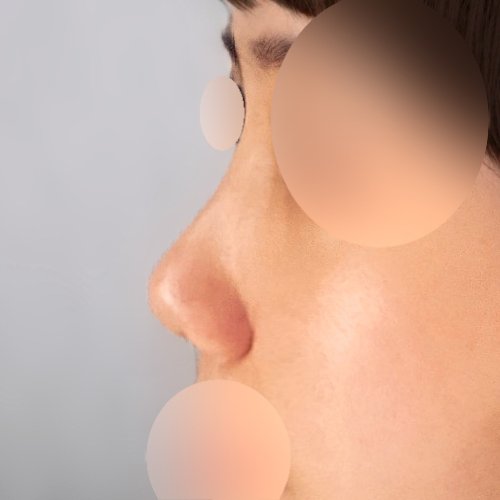 코재수술 후기