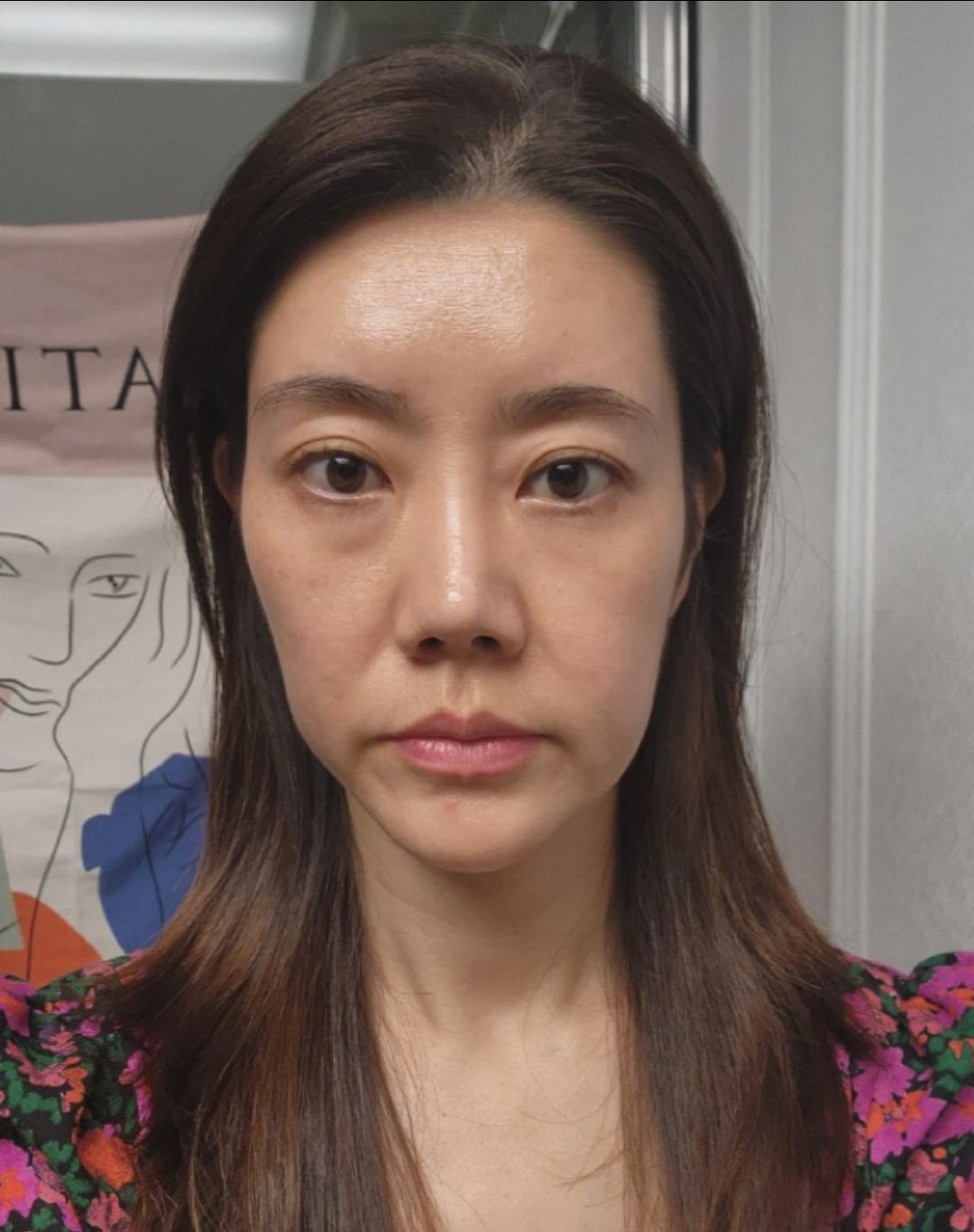 풀페이스지방이식 후기