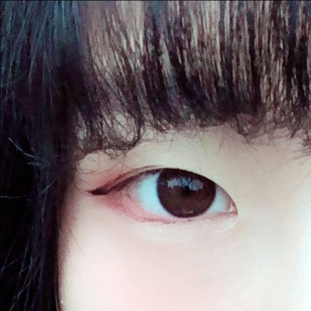 쌍꺼풀(절개) 후기