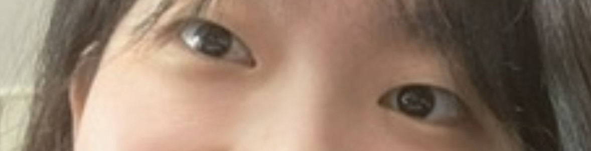 쌍꺼풀(절개) 후기