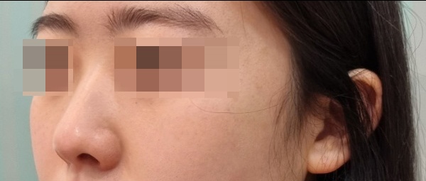 매부리코성형 후기