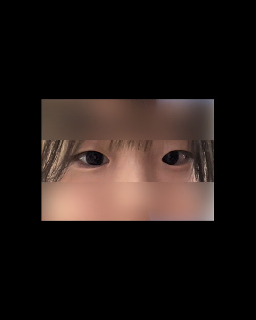 쌍꺼풀(자연유착) 후기