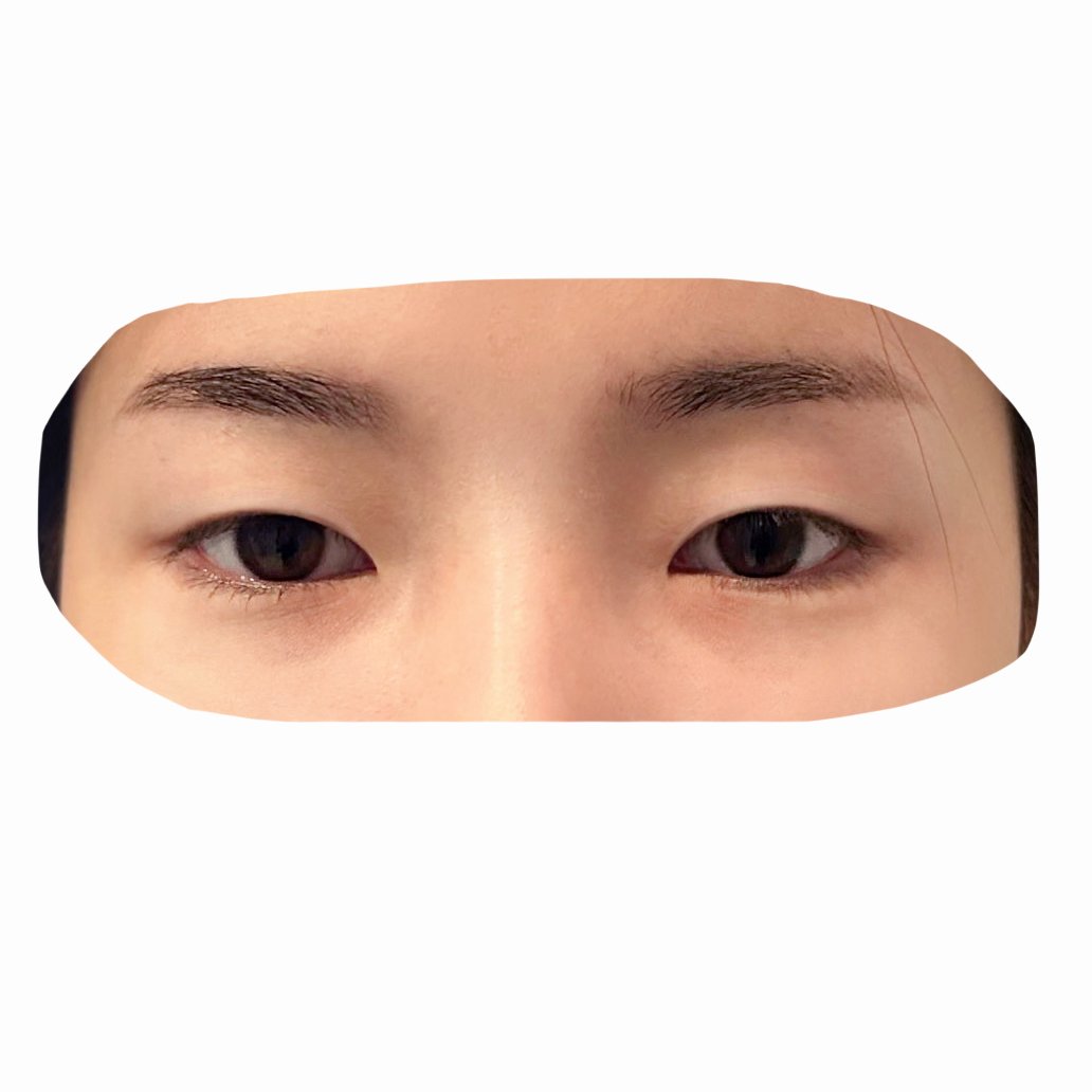 쌍꺼풀(절개) 후기