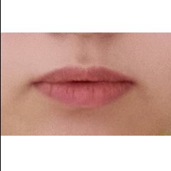입꼬리성형 후기