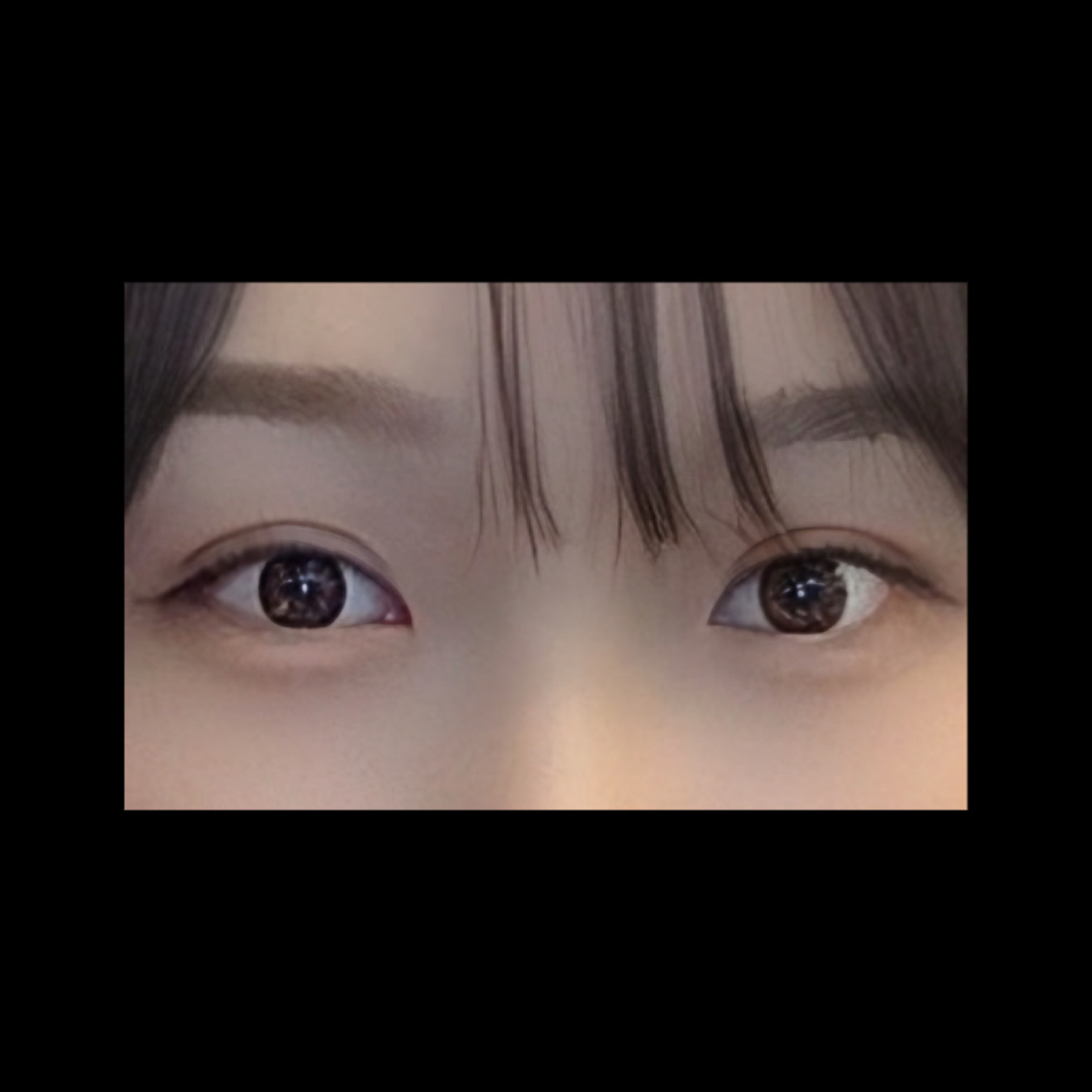눈재수술 후기