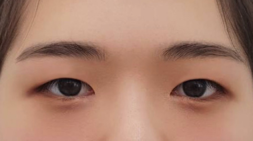 쌍꺼풀(절개) 후기