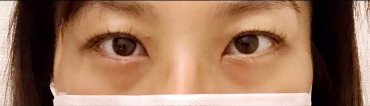 눈재수술 후기