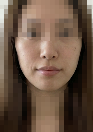 온다리프팅 후기