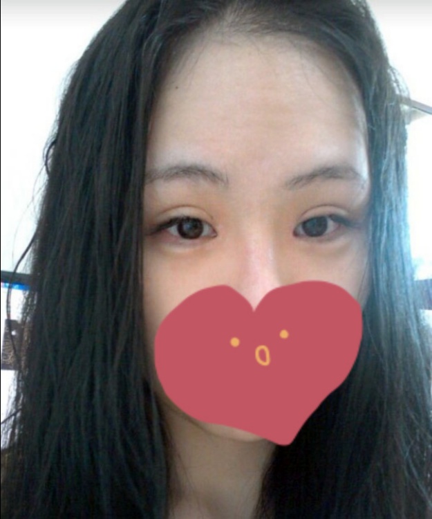 눈재수술 후기