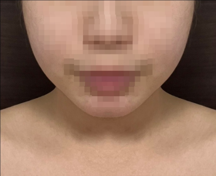 실리프팅 후기