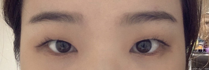 쌍꺼풀(절개) 후기
