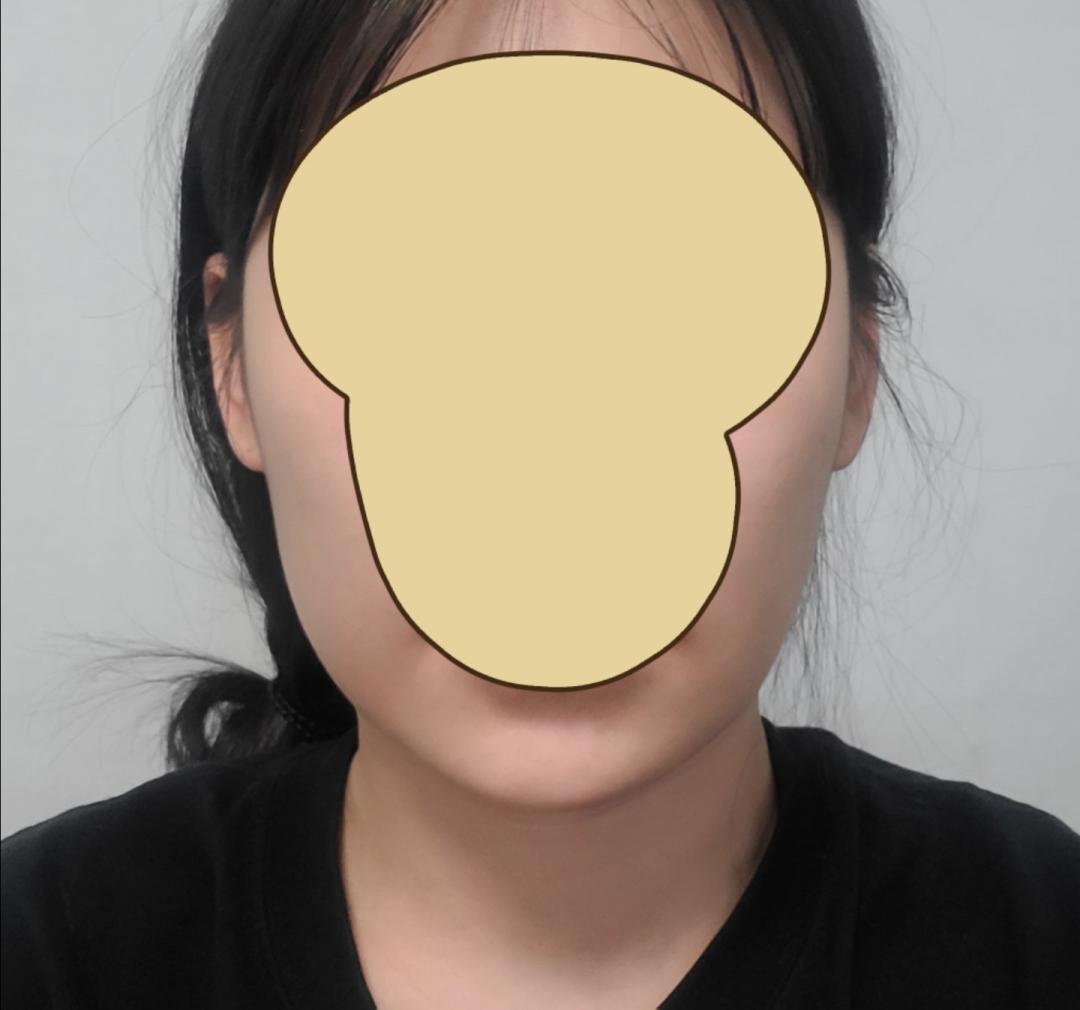 실리프팅 후기