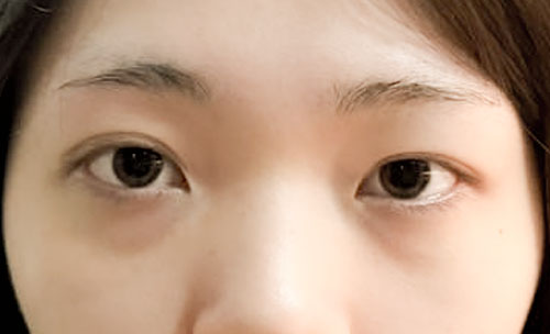 쌍꺼풀(자연유착) 후기