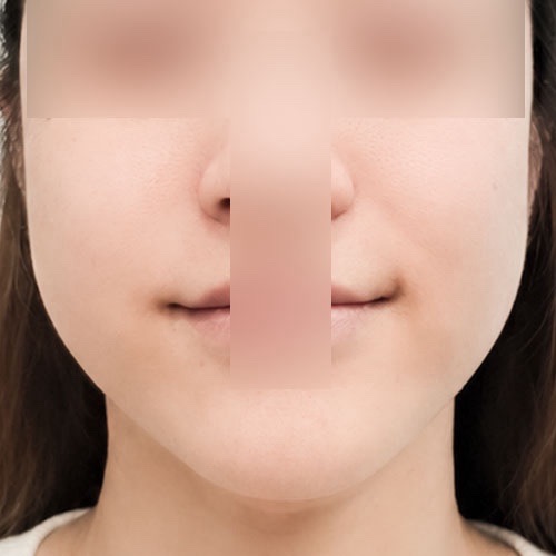 실리프팅 후기