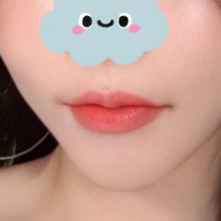 입꼬리성형 후기