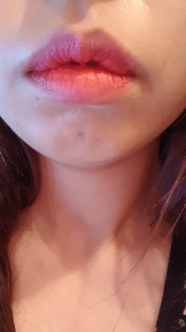 입꼬리성형 후기