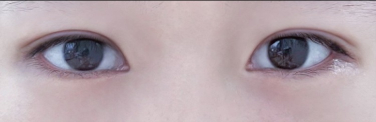 눈재수술 후기