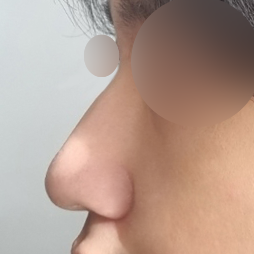 콧대(보형물) 후기