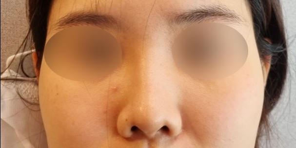 코재수술 후기