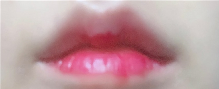 입꼬리성형 후기