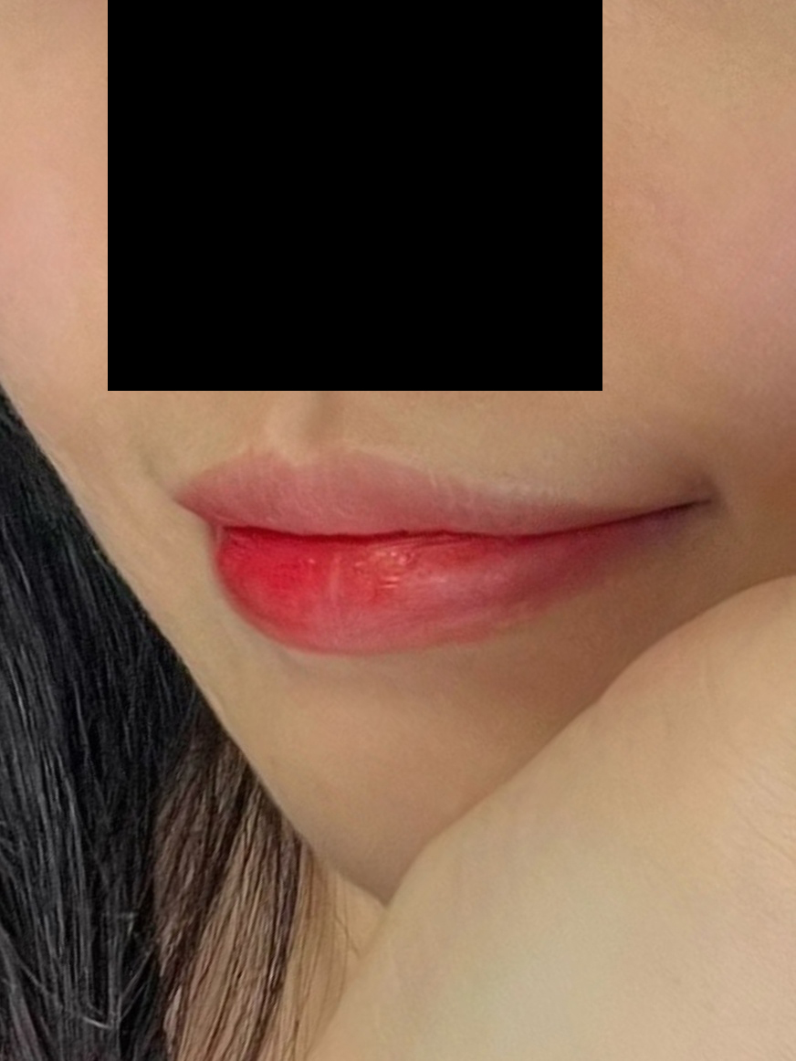 큐피트라인성형 후기