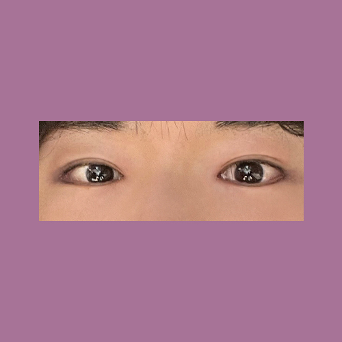 눈재수술 후기