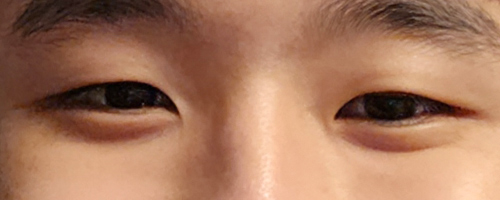 쌍꺼풀(자연유착) 후기